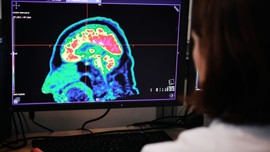 Alzheimer'la mücadelede önemli gelişme