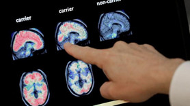 ABD'de beyin yiyen amip tespit edildi